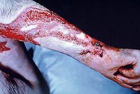 Sårdannelse i underarmens hud med sporotrichosis