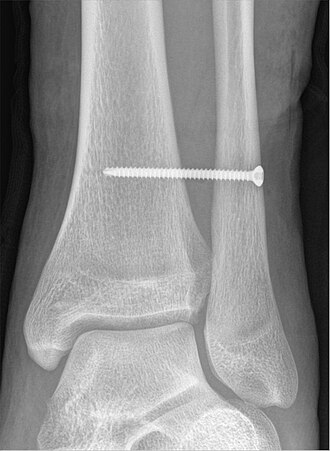 X-ray of a syndesmotic screw in place. Stellschraube fibulotibial bei Syndesmosenverletzung 27M - CR ap - 001.jpg