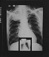 1939 X-ray of active tuberculosis condition.jpg
