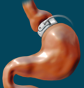 Thumbnail for Adjustable gastric band