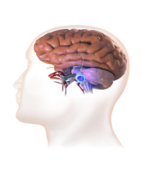 Acoustic neuroma.