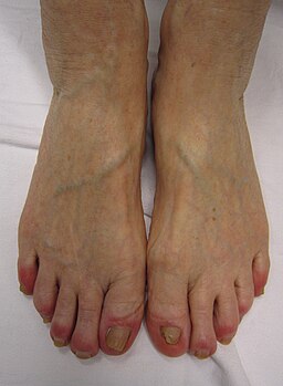 Chilblains from excessively icing the feet