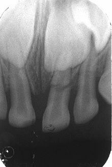 File:Fracture couronne dent temporaire.jpg - Wikimedia Commons