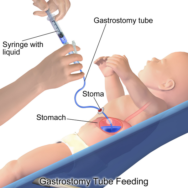 File:Gastric Feeding Tube Infant.png