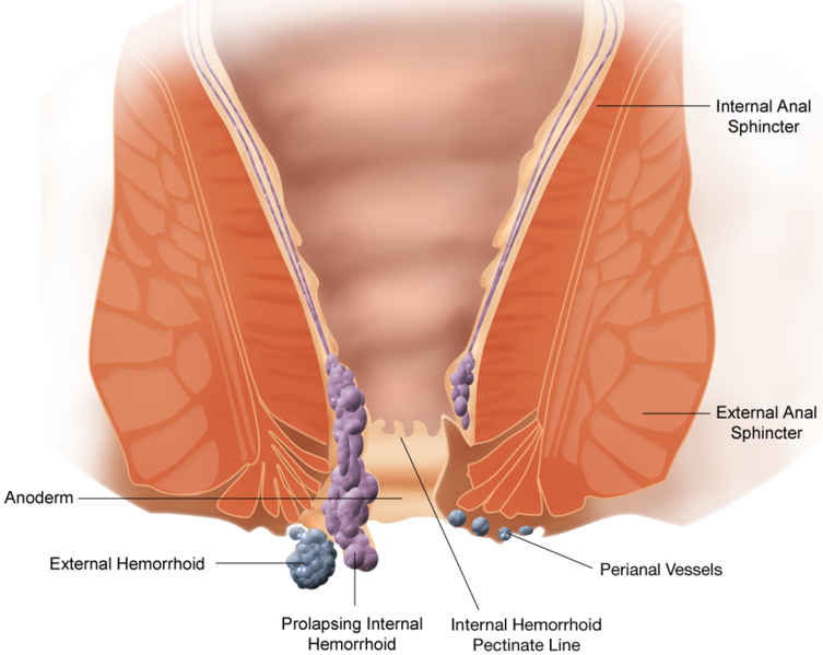 Dosiye:Hemorrhoid.png