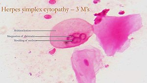 Herpes Simple: Etimologia, Signes i símptomes, Patofisiologia