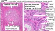 Thumbnail for Noninvasive follicular thyroid neoplasm with papillary-like nuclear features