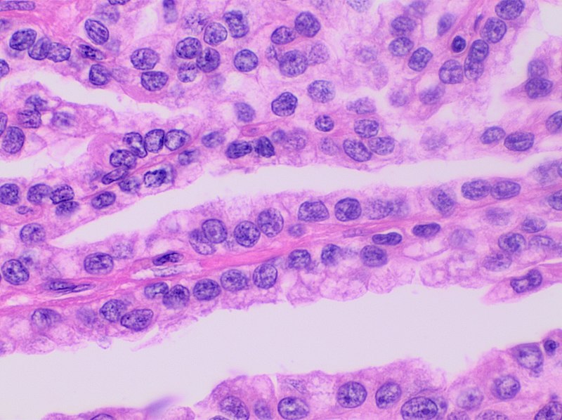 File:Histopathology of papillary renal cell carcinoma type 1 grade 2, very high magnification.jpg