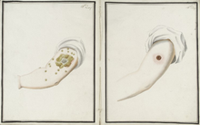 Comparison of smallpox (left) and cowpox inoculations sixteen days after administration (1802) Inoculation day 16.png