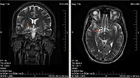 Tumeur du cerveau