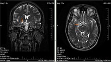 Low-grade brain glioma in a 28-year-old male. (Taken on 10 July 2007) MRI glioma 28 yr old male.JPG