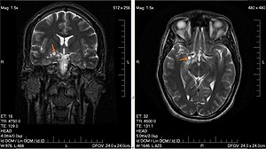 Tumor Otak: Penyakit yang menyerang otak