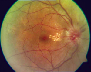 PMID20029144 07 neuroretinitis.png