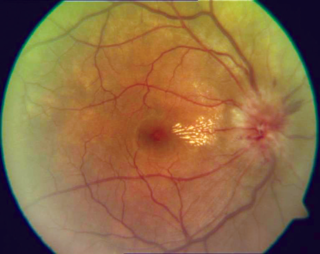 <span class="mw-page-title-main">Optic neuritis</span> Medical condition