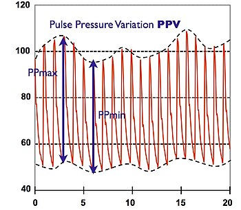 Respiratory changes of blood pressure - the change of pulse pressure maximum (PPmax) to minimum (PPmin) is called PPV (in %). Pulse pressure variation.jpg