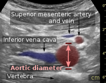 Standard measurement of the abdominal aorta Ultrasonographic measurement of aortic diameter at the navel.svg