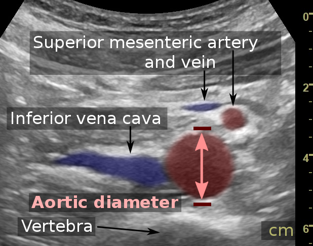 File:Ultrasonographic measurement of aortic diameter at the navel.svg