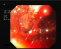 Thumbnail for File:Bleeding esophageal varices.png