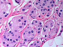 Fig. 2 Breast apocrine carcinoma Breast ApocrineCarcinoma HP2 CTR.jpg