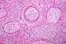 Micrograph of a Brenner tumour. H&E stain. Brenner tumour intermed mag.jpg