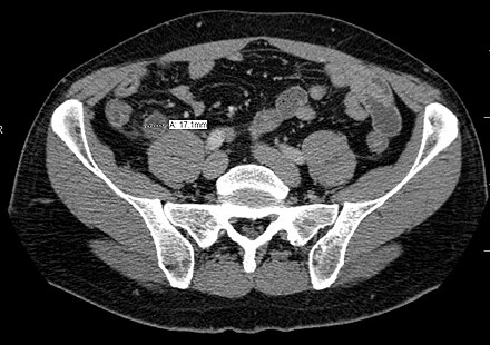 A CT scan demonstrating acute appendicitis (note the appendix has a diameter of 17.1 mm and there is surrounding fat stranding)