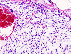 Chondrosarcoma histological image 4