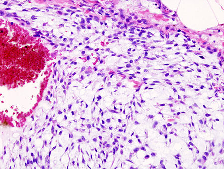 Chondrosarcoma (5).jpg