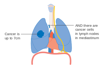 Stage IIIA lung cancer