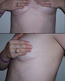 lung transplant scar