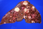 Liver metastases of pancreatic carcinoma.