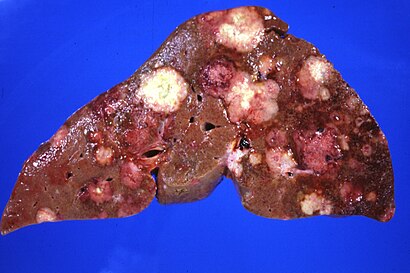 Human liver with metastatic lesions from primary pancreas carcinoma (2).jpg