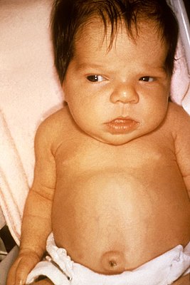 Jaundice in newborn.jpg