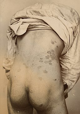 Man with a ringworm infection on his back Wellcome L0061931