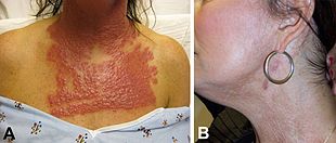 A) Neck and chest of a 53-year-old woman 14 days after fractionated CO2 laser resurfacing, showing nontuberculous mycobacterial infection B) Neck of the patient after five months of multidrug therapy and pulsed dye laser treatment. Nontuberculous Mycobacterial Infection on neck and chest.jpg