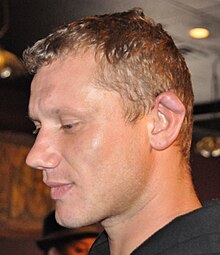 Cauliflower ear in an MMA fighter Shawn's cauliflower ear.jpg