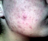 Teenager-with-acne.jpg