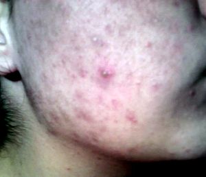 Tenåring-med-acne.jpg