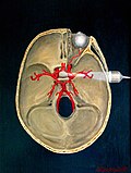 Vignette pour Détection de microemboles par doppler transcrânien