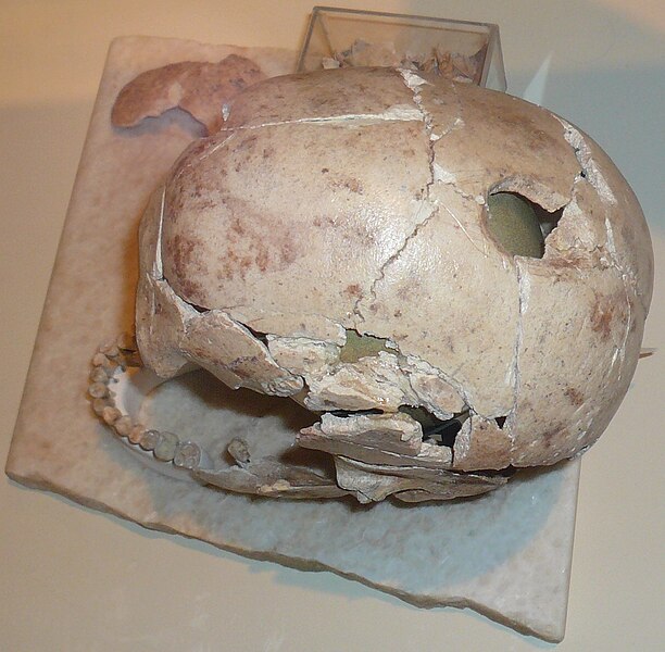 File:Trepanated Skull.jpg