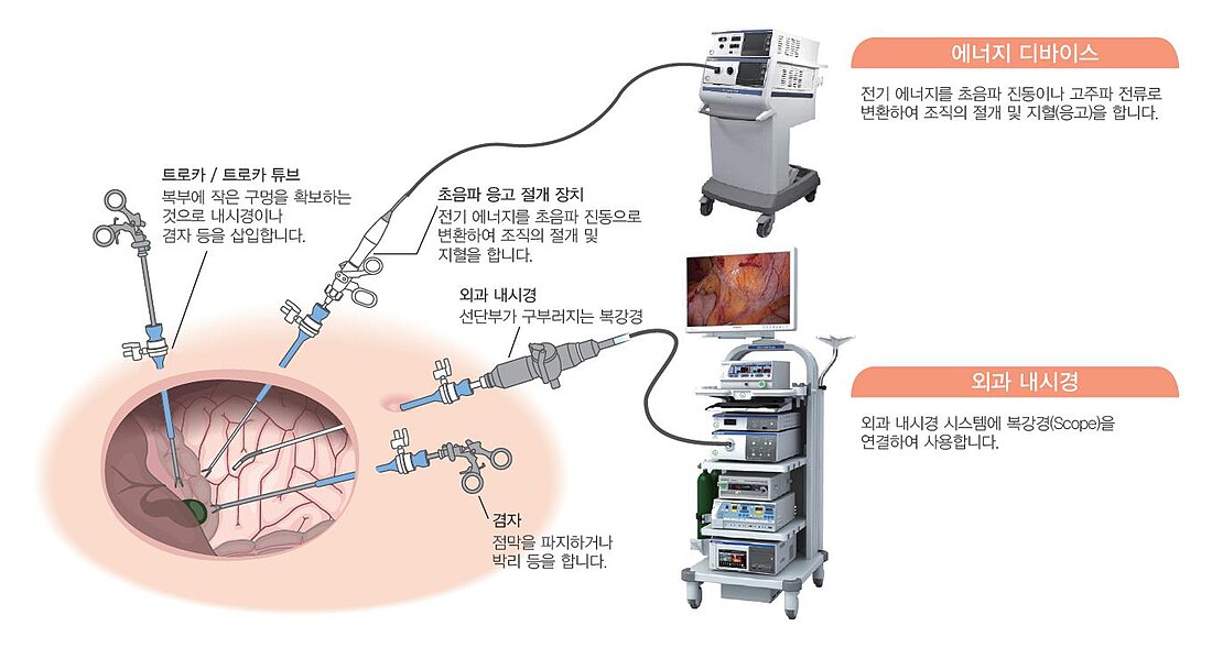 복강경 수술