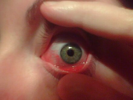 Eye with mild allergic conjunctivitis