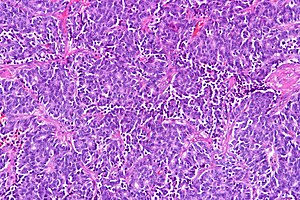 Atypický plicní karcinoidní nádor, vysoká mag. 1.jpg