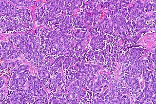 <span class="mw-page-title-main">Atypical pulmonary carcinoid tumour</span> Medical condition