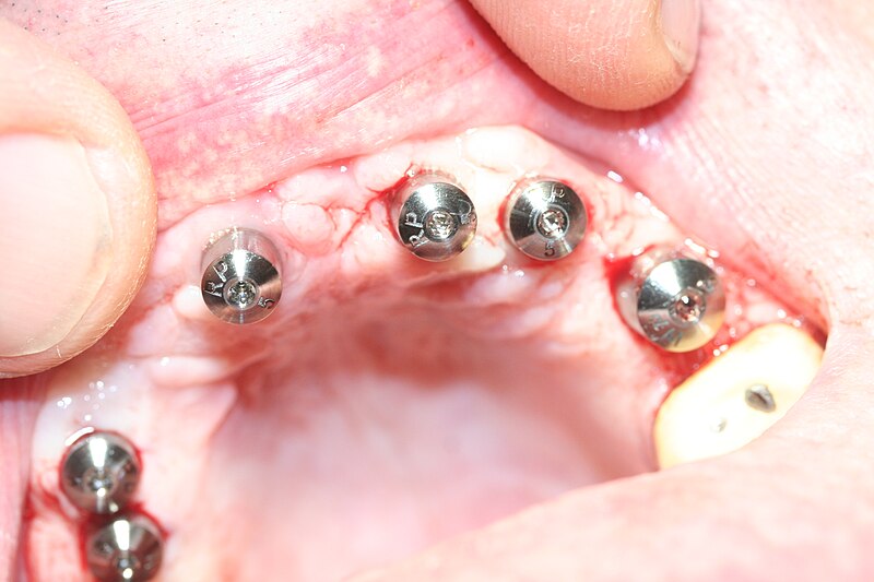 File:Bridge on implants, implants and healing abutments in place.jpg