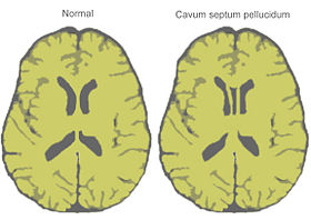 Cavum septum pellucidum diagram