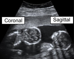 Identical twins at a gestational age of 15 weeks, shown in coronal and sagittal plane, respectively