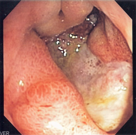 Endoscopic image of a peptic ulcer of the stomach.
