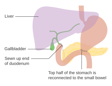 File:Diagram showing the anatomy after a partial gastrectomy (Bilroth 02) CRUK 281.svg