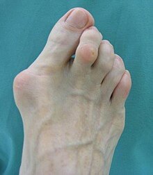 Bunion and hammer toe Hallux valgus und Krallenzehe II (praop.).jpg