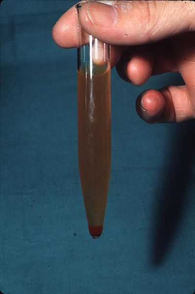 File:Hematuria.jpg